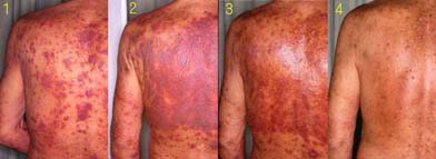 Long term effects of steroids on skin