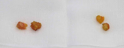 目袋(下まぶた)のたるみ取り施術で取れた脂肪