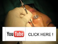 目袋(下まぶた)のたるみ取り施術動画