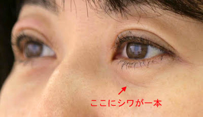 目袋(下まぶた)のしわ