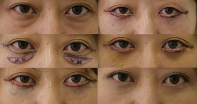 下まぶたのたるみ取り施術経過