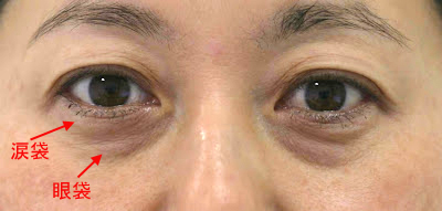 目袋(下まぶた)のたるみ取り施術前