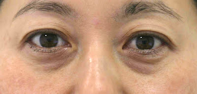 目袋(下まぶた)のたるみ取り施術前