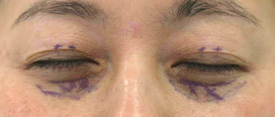 目袋(下まぶた)のたるみ取り施術デザイン