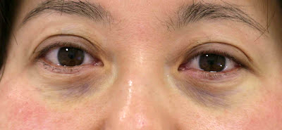 目袋(下まぶた)のたるみ取り施術直後