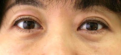 目袋(下まぶた)のたるみ取り施術2日後