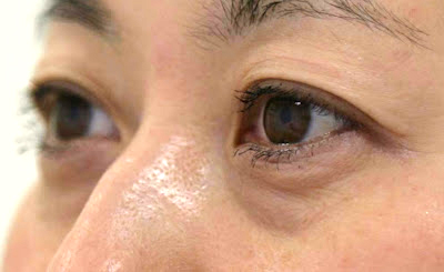 目袋(下まぶた)のたるみ取り施術前斜め