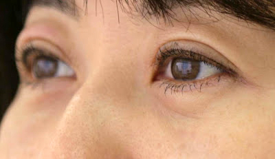 目袋(下まぶた)のたるみ取り施術2日後斜め