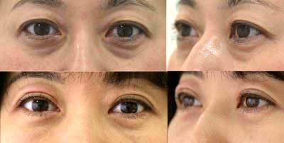 目袋(下まぶた)のたるみ取り施術比較