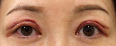 切り取る上まぶたのたるみ取り施術24時間後