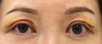 切り取る上まぶたのたるみ取り施術3日後