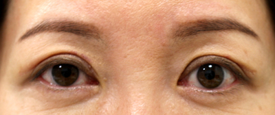 切り取る上まぶたのたるみ取り施術1週間後抜糸