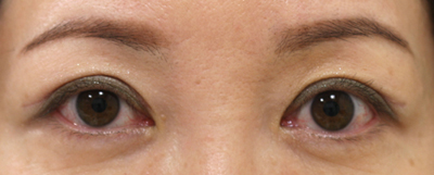 切り取る上まぶたのたるみ取り施術1ヶ月後