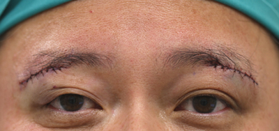 眉の下のたるみ取り施術直後