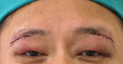 眉の下のたるみ取り施術翌日