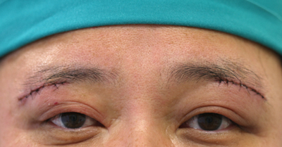眉の下のたるみ取り施術3日後