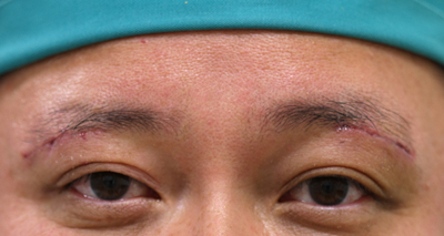 眉の下のたるみ取り施術1週間後抜糸