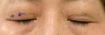 二重埋没法の施術デザイン