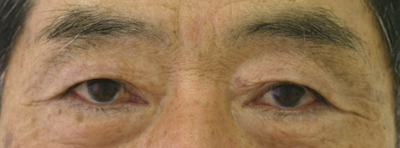 切り取る上まぶたのたるみ施術前