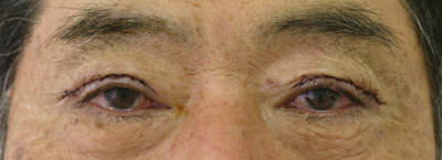 切り取る上まぶたのたるみ施術直後