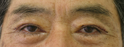 切り取る上まぶたのたるみ施術4日後