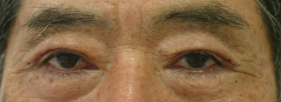 切り取る上まぶたのたるみ施術1週間後抜糸