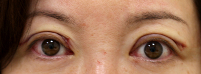 切り取る上まぶたのたるみ取り施術直後