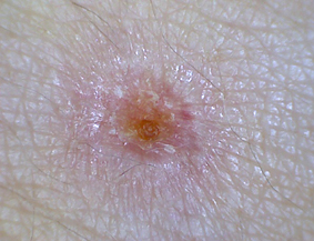 CO2レーザーのほくろ取り施術1週間後