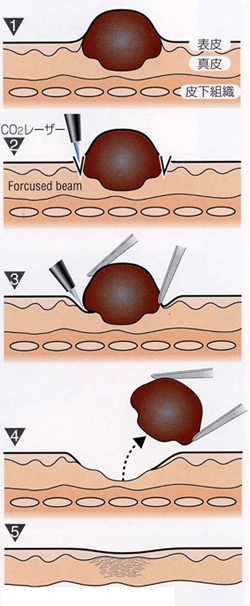 CO2レーザーのほくろ取り施術後の注意