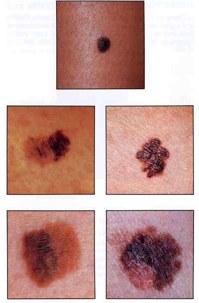 良性のほくろと悪性のほくろ