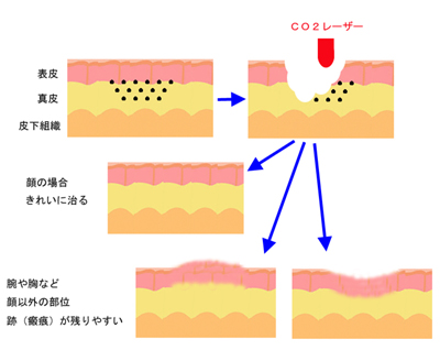 CO2レーザーのほくろを除去イメージ
