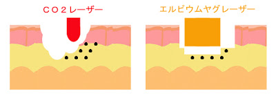 エルビウムヤグレーザーとCO2レーザーとでのほくと取り比較