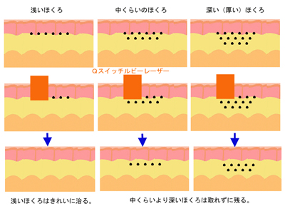 Qスイッチルビーレーザーのほくろ色素