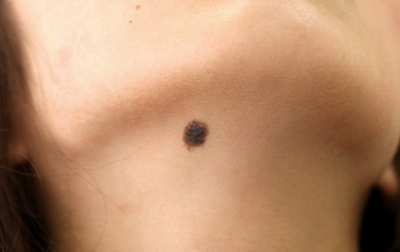 大きめなほくろの切除
