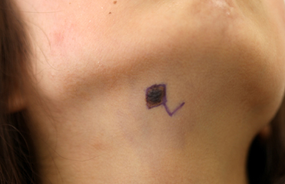 大きめのほくろ切除デザイン