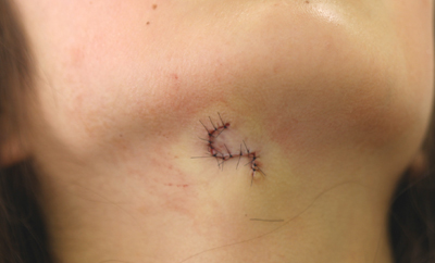 大きめのほくろ切除施術後