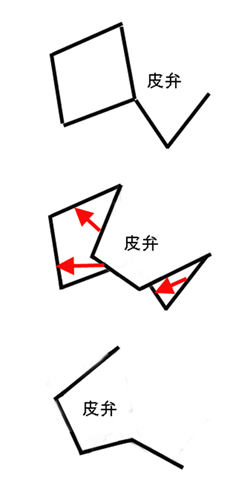 大きめのほくろ切除の解説