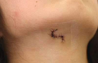 大きめのほくろの除去施術1週間後