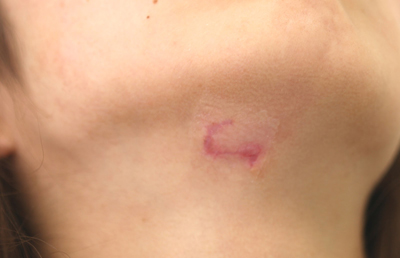 大きめのほくろの除去施術1ヶ月後