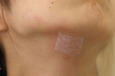 大きめのほくろの除去施術1週間後テーピング