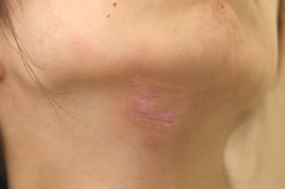 大きめのほくろの除去施術4ヶ月後