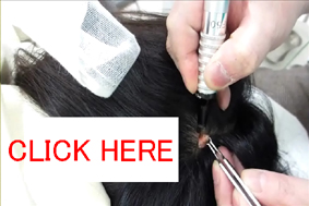 色のないほくろを取る動画