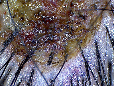 色のないほくろを切除した部分の拡大