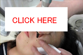 小さなほくろを取っている動画