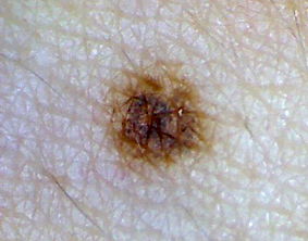 CO2レーザーのほくろ取り施術前