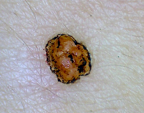 CO2レーザーのほくろ取り施術直後