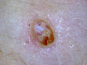 CO2レーザーのほくろ取り施術拭き取り後