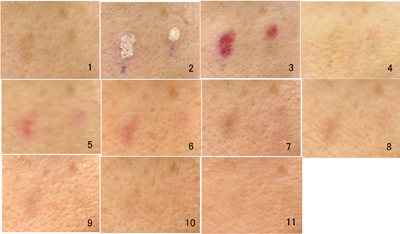 しみのQスイッチレーザー施術経過