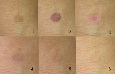 腕のしみのQスイッチレーザー施術経過