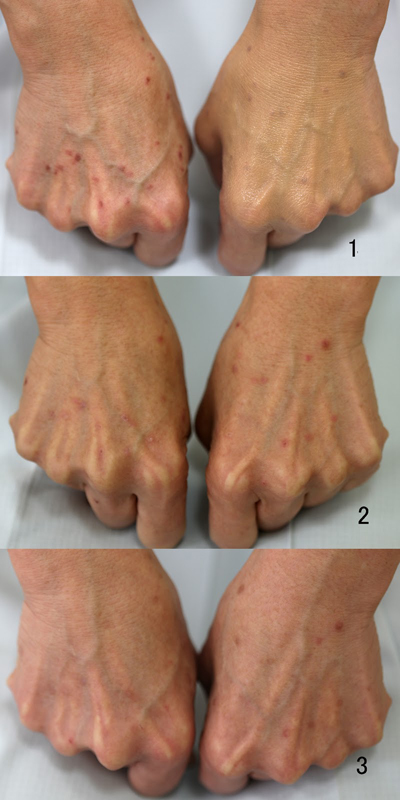 しみ取り後のハイドロキノン軟膏使用